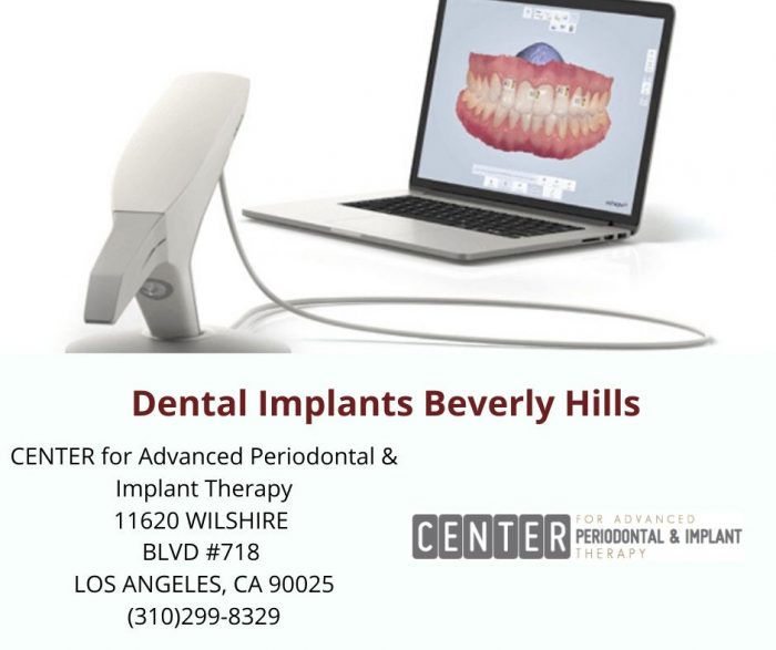 Dental Implants Beverly Hills
